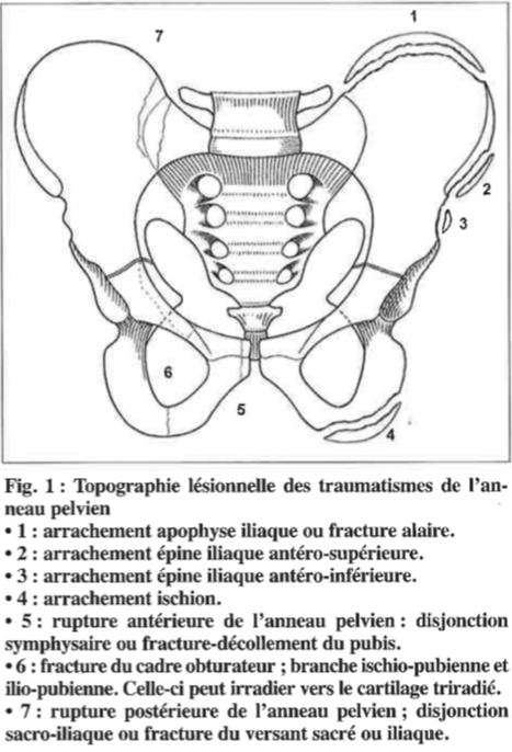 PDF) Les fractures de l'anneau pelvien : aspects épidémiologiques